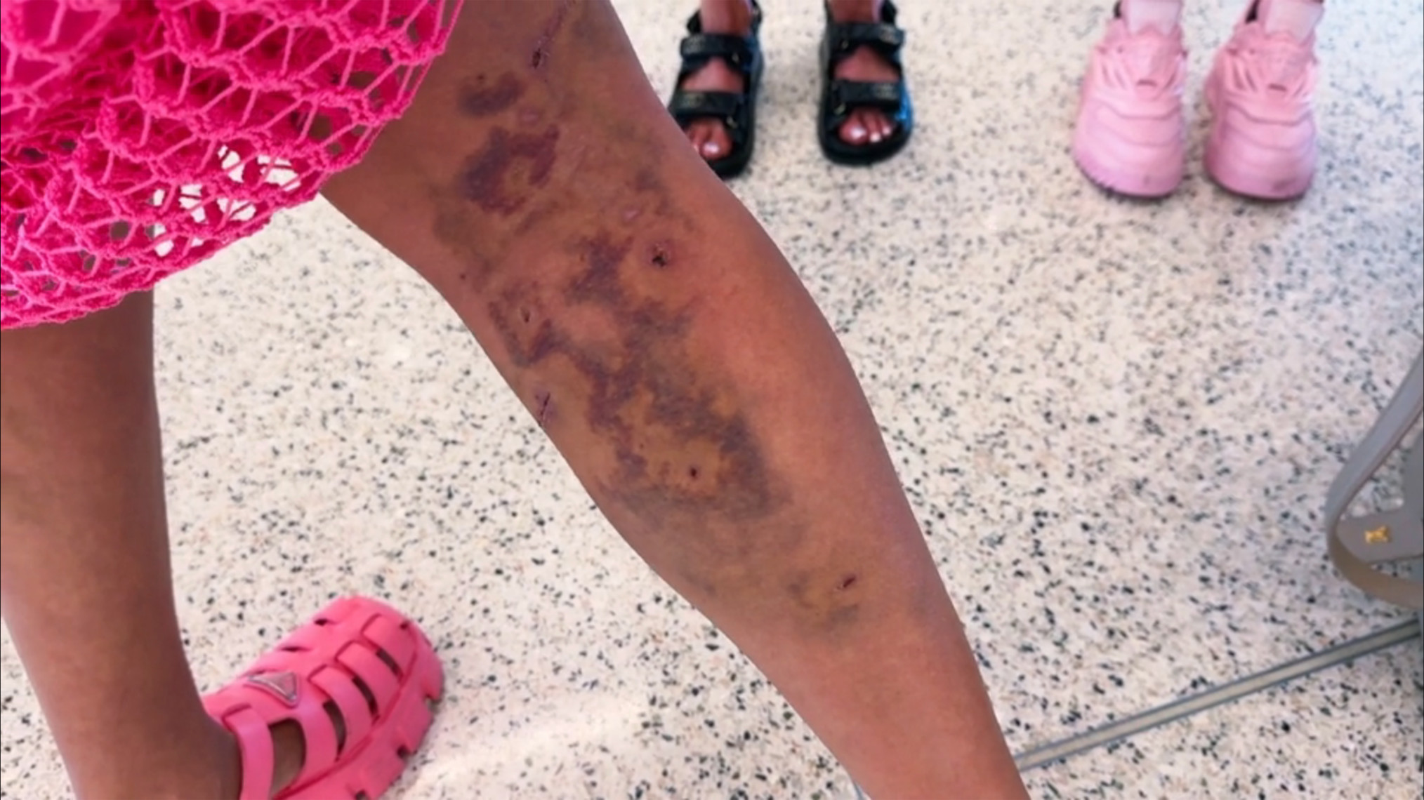 ‘RHOSLC’ Star Bronwyn Newport Details Dog Attack: ‘I Had 37 Separate Bites’