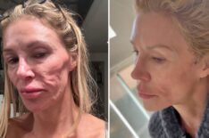 Brandi Glanville Gives ‘Miserable’ Health Update: ‘My Face Is Worse Than Ever’