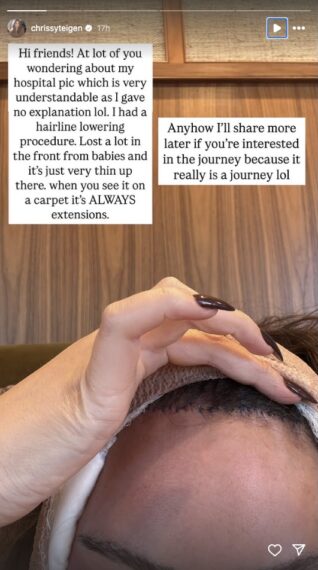 Chrissy Teigen's Instagram Stories update about her hairline lowering procedure