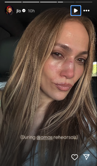 Jennifer Lopez reveals face injury after AMAs