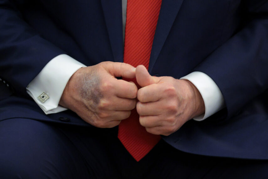 A bruise is visible on the back of U.S. President Donald Trump's right hand during a meeting with South Korean President Lee Jae-myung in the Oval Office at the White House on August 25, 2025 in Washington, DC.