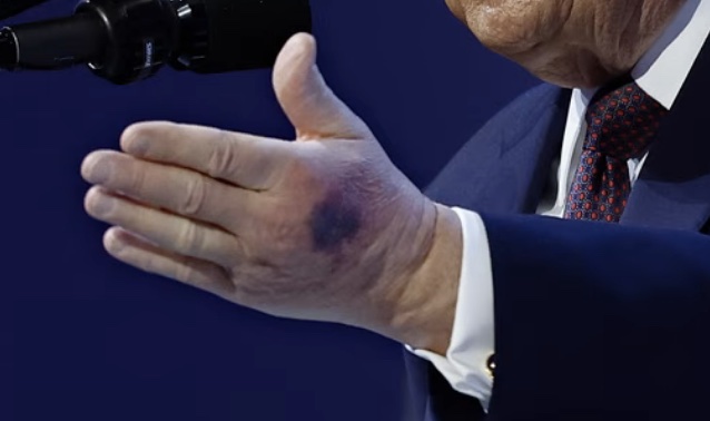 Donald Trump's bruised hand