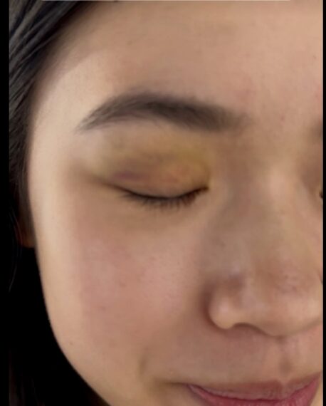 Natalie Jolley's black eye