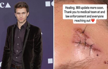 Keegan Allen attends the MOCA Benefit 2019 at The Geffen Contemporary at MOCA on May 18, 2019, in Los Angeles, California; his photo of his stitches, posted on October 10, 2026